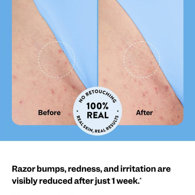 Ingrown Hair Treatment